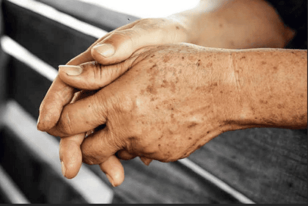 CryoPen for Age Spots: How Cryotherapy Works and What to Expect 1 Can CryoPen Treat an Age Spot?
